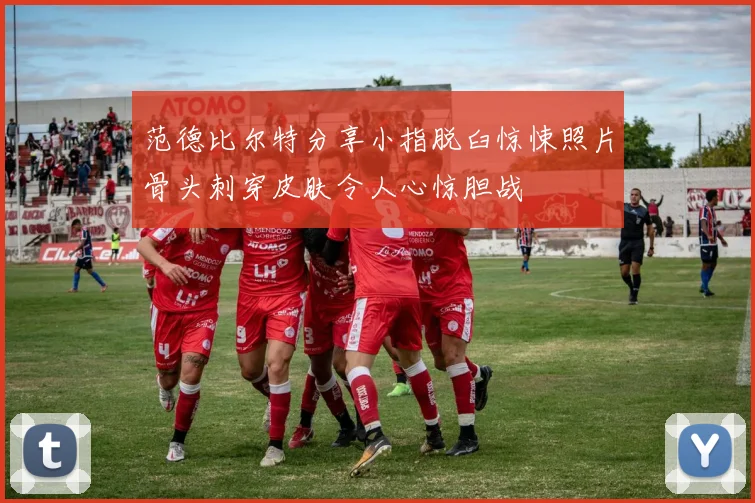 范德比尔特分享小指脱臼惊悚照片骨头刺穿皮肤令人心惊胆战